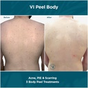 VI Peel - VI Peel Body