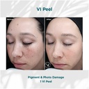 VI PEEL (The Original) Before and After
