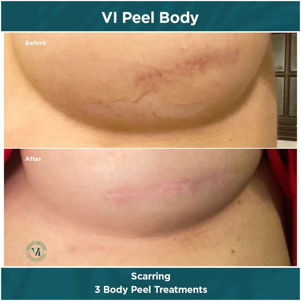VI Peel - VI Peel Body